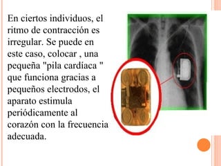 En ciertos individuos, el ritmo de contracción es irregular. Se puede en este caso, colocar , una pequeña "pila cardíaca " que funciona gracias a pequeños electrodos, el aparato estimula periódicamente al corazón con la frecuencia adecuada. 