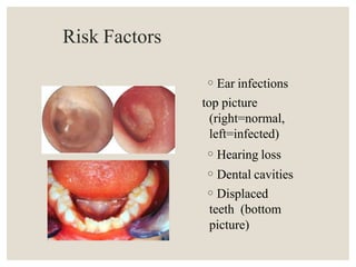 Risk Factors
◦Ear infections
top picture
(right=normal,
left=infected)
◦Hearing loss
◦Dental cavities
◦Displaced
teeth (bottom
picture)
 