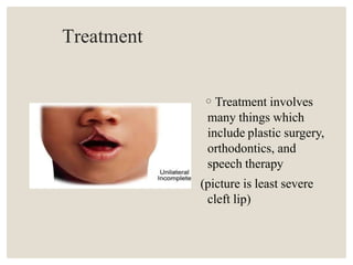 Treatment
◦Treatment involves
many things which
include plastic surgery,
orthodontics, and
speech therapy
(picture is least severe
cleft lip)
 