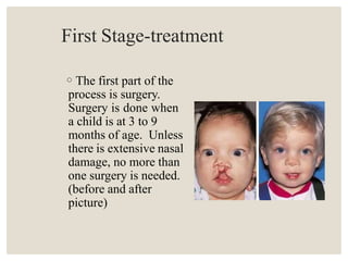 First Stage-treatment
◦The first part of the
process is surgery.
Surgery is done when
a child is at 3 to 9
months of age. Unless
there is extensive nasal
damage, no more than
one surgery is needed.
(before and after
picture)
 