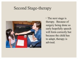 Second Stage-therapy
◦The next stage is
therapy. Because of
surgery being done so
early hopefully speech
will form correctly but
because the child has
to adapt, therapy is
advised.
 