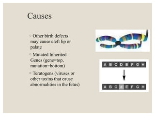 Causes
◦Other birth defects
may cause cleft lip or
palate
◦Mutated Inherited
Genes (gene=top,
mutation=bottom)
◦Teratogens (viruses or
other toxins that cause
abnormalities in the fetus)
 