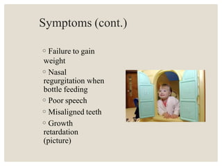 Symptoms (cont.)
◦Failure to gain
weight
◦Nasal
regurgitation when
bottle feeding
◦Poor speech
◦Misaligned teeth
◦Growth
retardation
(picture)
 