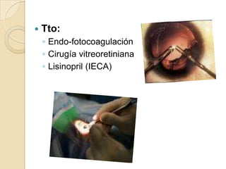  Tto:
◦ Endo-fotocoagulación
◦ Cirugía vitreoretiniana
◦ Lisinopril (IECA)
 