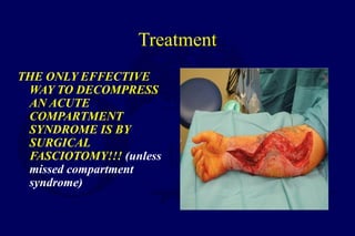 Treatment
THE ONLY EFFECTIVE
WAY TO DECOMPRESS
AN ACUTE
COMPARTMENT
SYNDROME IS BY
SURGICAL
FASCIOTOMY!!! (unless
missed compartment
syndrome)
 