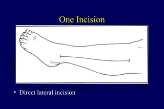One Incision
• Direct lateral incision
 
