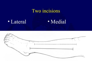 Two incisions
• Lateral • Medial
 