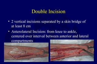 Double Incision
• 2 vertical incisions separated by a skin bridge of
at least 8 cm
• Anterolateral Incision: from knee to ankle,
centered over interval between anterior and lateral
compartments
 