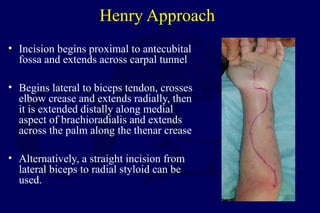 Henry Approach
• Incision begins proximal to antecubital
fossa and extends across carpal tunnel
• Begins lateral to biceps tendon, crosses
elbow crease and extends radially, then
it is extended distally along medial
aspect of brachioradialis and extends
across the palm along the thenar crease
• Alternatively, a straight incision from
lateral biceps to radial styloid can be
used.
 