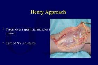Henry Approach
• Fascia over superficial muscles is
incised
• Care of NV structures
 