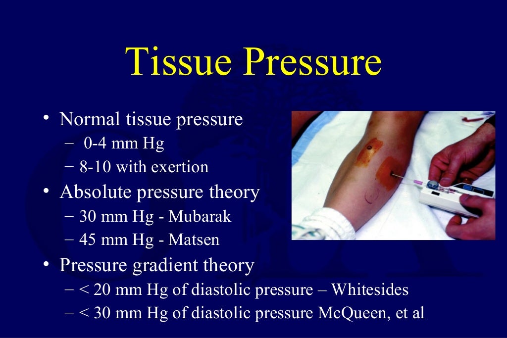 compartment syndrome