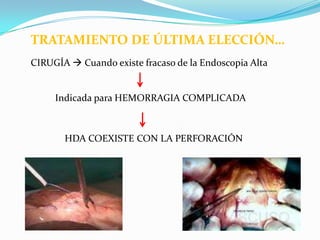 TRATAMIENTO DE ÚLTIMA ELECCIÓN…
CIRUGÍA  Cuando existe fracaso de la Endoscopia Alta


     Indicada para HEMORRAGIA COMPLICADA



       HDA COEXISTE CON LA PERFORACIÓN
 