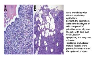 Cysts were lined with
normal respiratory
epithelium.
Beneath the epithelium
were band-like layers of
cells composed of
primitive mesenchymal-
like cells with dark oval
nuclei, scanty
cytoplasm, and very rare
mitoses .
Scattered or clustered
mature fat cells were
present in some areas of
the cysts and nodules
 