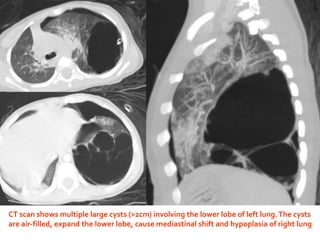 CT scan shows multiple large cysts (>2cm) involving the lower lobe of left lung.The cysts
are air-filled, expand the lower lobe, cause mediastinal shift and hypoplasia of right lung
 