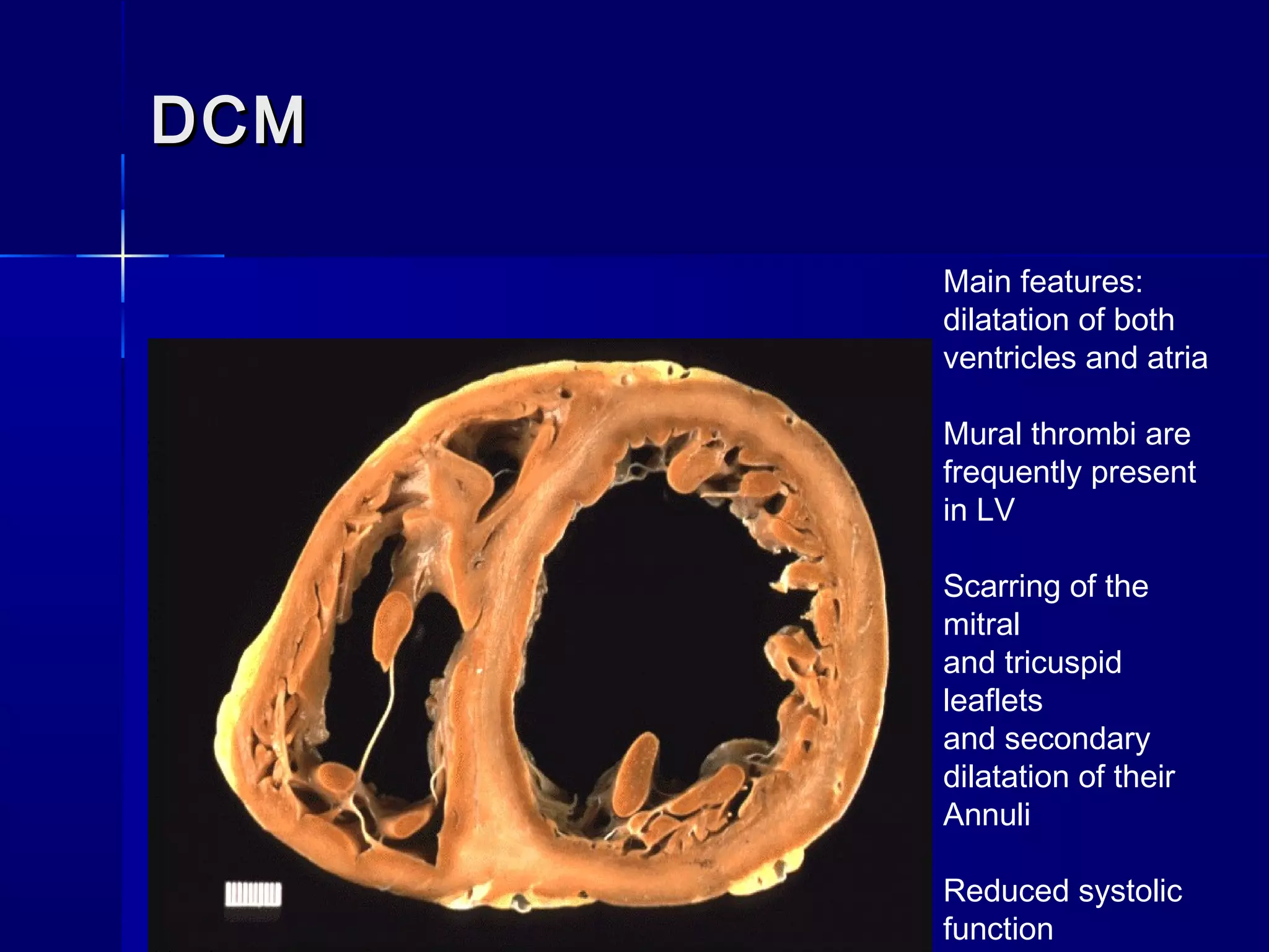 Approach to patient with Dilated Cardiomyopathy | PPT
