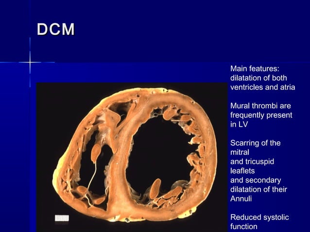 Approach To Patient With Dilated Cardiomyopathy