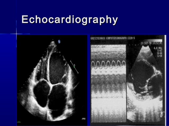 Approach to patient with Dilated Cardiomyopathy