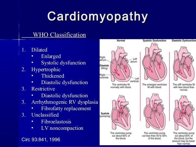 approach to patient with dilated cardiomyopathy