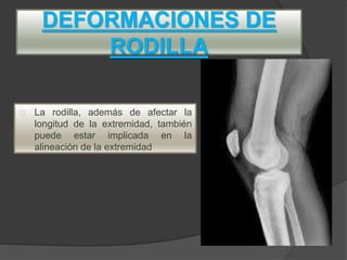 DEFORMACIONES DE
RODILLA
La rodilla, además de afectar la
longitud de la extremidad, también
puede estar implicada en la
alineación de la extremidad
 