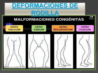 DEFORMACIONES DE
RODILLA
 