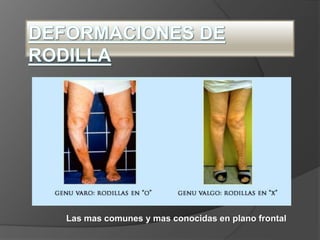 Las mas comunes y mas conocidas en plano frontal
 