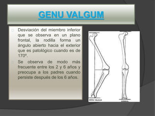 GENU VALGUM
Desviación del miembro inferior
que se observa en un plano
frontal, la rodilla forma un
ángulo abierto hacia el exterior
que es patológico cuando es de
170º.
Se observa de modo más
frecuente entre los 2 y 6 años y
preocupa a los padres cuando
persiste después de los 6 años.
 