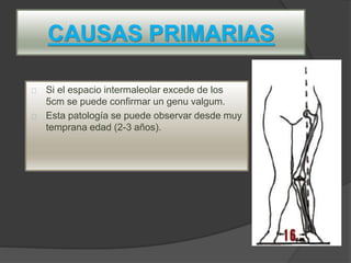 CAUSAS PRIMARIAS
Si el espacio intermaleolar excede de los
5cm se puede confirmar un genu valgum.
Esta patología se puede observar desde muy
temprana edad (2-3 años).
 