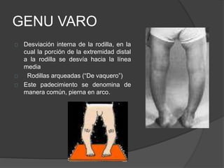 GENU VARO
Desviación interna de la rodilla, en la
cual la porción de la extremidad distal
a la rodilla se desvía hacia la línea
media
Rodillas arqueadas (“De vaquero”)
Este padecimiento se denomina de
manera común, pierna en arco.
 