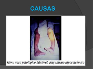 CAUSAS
 