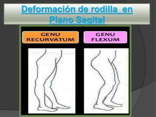 Deformación de rodilla en
Plano Sagital
 