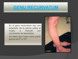 GENU RECURVATUM
En el genu recurvatum hay una
extensión de la pierna sobre el
muslo, a menudo con
movimiento de lateralidad.
Se tolera bien hasta cierto grado
que es de 5º a 10º
 