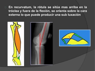 En recurvatum, la rótula se sitúa mas arriba en la
tróclea y fuera de la flexión, se orienta sobre la cara
externa lo que puede producir una sub luxación
 