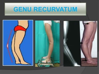 GENU RECURVATUM
 