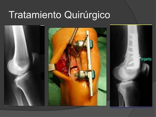 Tratamiento Quirúrgico
 