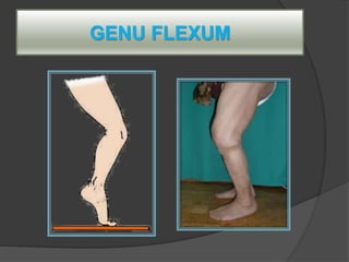 GENU FLEXUM
 
