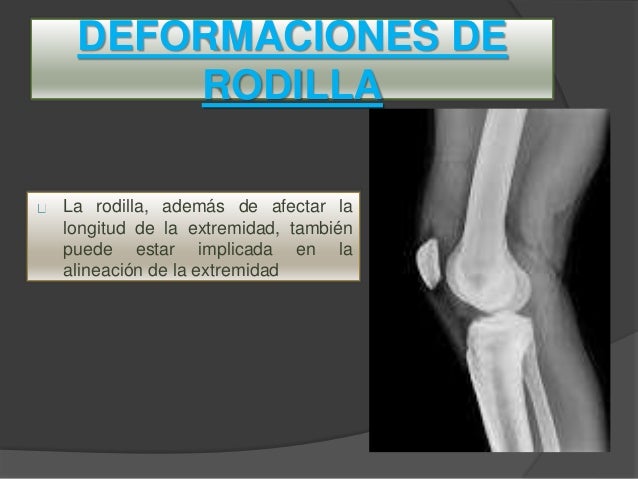 deformidades de rodilla