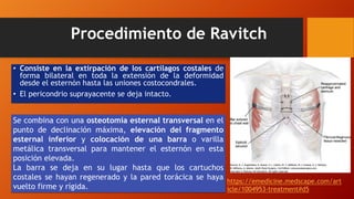 Ravitch Incision Corrección de Pectus Excavatum | PPTX