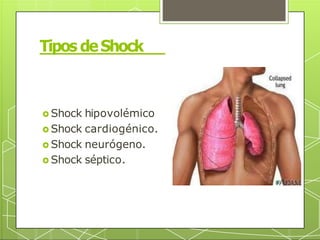 Tipos deShock
🞇 Shock hipovolémico
🞇 Shock cardiogénico.
🞇 Shock neurógeno.
🞇 Shock séptico.
 