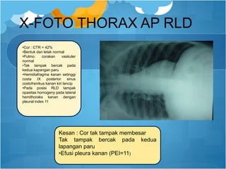 X-FOTO THORAX AP RLD
•Cor : CTR = 42%
•Bentuk dan letak normal
•Pulmo: corakan vaskuler
normal
•Tak tampak bercak pada
kedua kapangan paru
•Hemidiafragma kanan setinggi
costa IX posterior sinus
costofrenikus kanan kiri lancip
•Pada posisi RLD tampak
opasitas homogeny pada lateral
hemithoraks kanan dengan
pleural index 11
Kesan : Cor tak tampak membesar
Tak tampak bercak pada kedua
lapangan paru
•Efusi pleura kanan (PEI=11)
 
