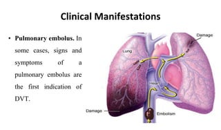 • Pulmonary embolus. In
some cases, signs and
symptoms of a
pulmonary embolus are
the first indication of
DVT.
Clinical Manifestations
 