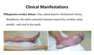Clinical Manifestations
Phlegmasia cerulea dolens. Also called massive iliofemoral venous
thrombosis, the entire extremity becomes massively swollen, tense,
painful , and cool to the touch.
 