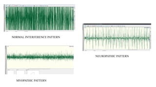 Normal Interference PPT ELECTROMYOGRAPHY BASICS INTERPRETATION AND WAVEFORM ANALYSIS.pptx