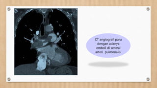 CT angiografi paru
dengan adanya
emboli di sentral
arteri pulmonalis.
 