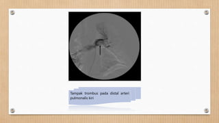 Tampak trombus pada distal arteri
pulmonalis kiri
 