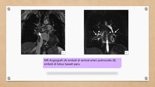 MR Angiografi (A) emboli di sentral arteri pulmonalis (B)
emboli di lobus bawah paru.
A B
 