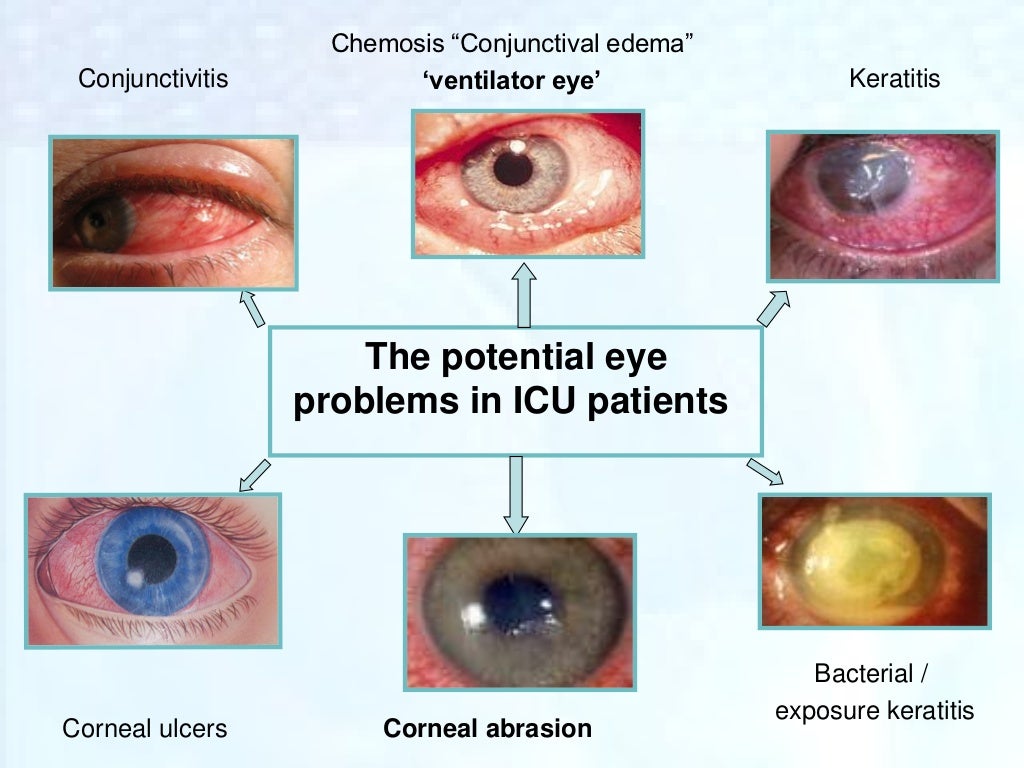 Ppt eye care.