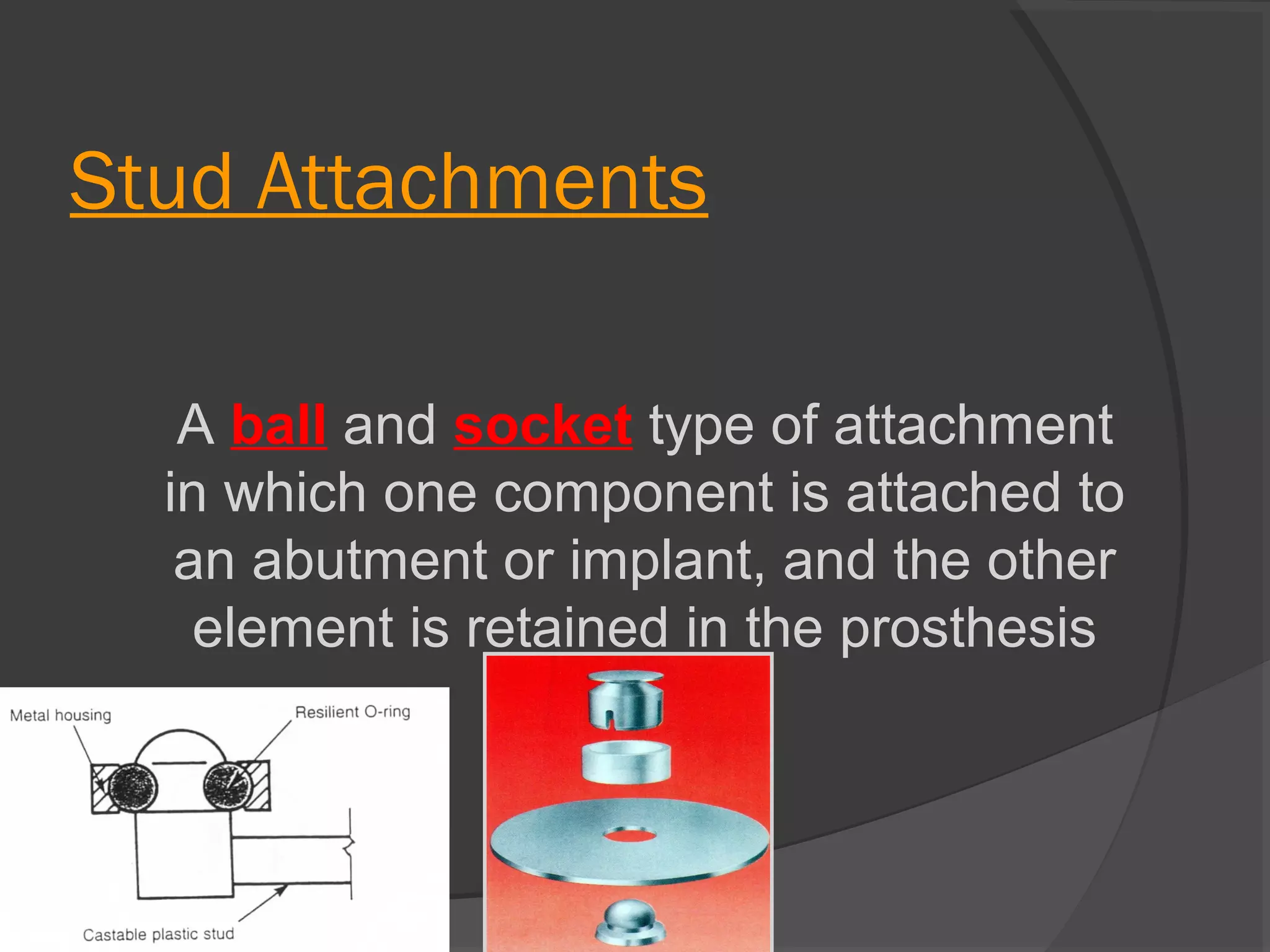 Stud Attachments
A ball and socket type of attachment
in which one component is attached to
an abutment or implant, and the other
element is retained in the prosthesis

 