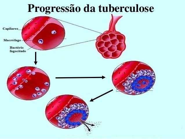 Artigos tuberculose