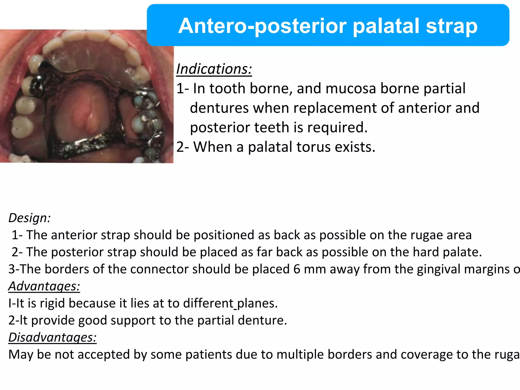 Palatable Strap Rpd PPT (FINAL)The principles of RPD design & its components (Year 3) .pptx