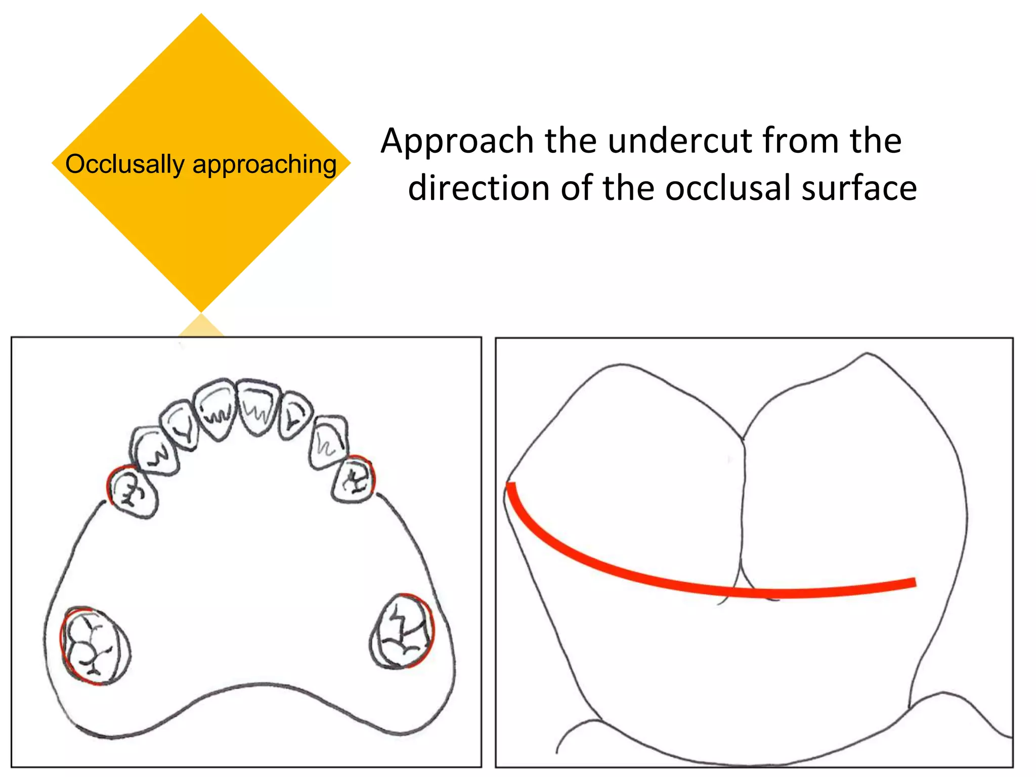 Occlusal Support Rpd PPT (FINAL)The principles of RPD design & its components (Year 3) .pptx